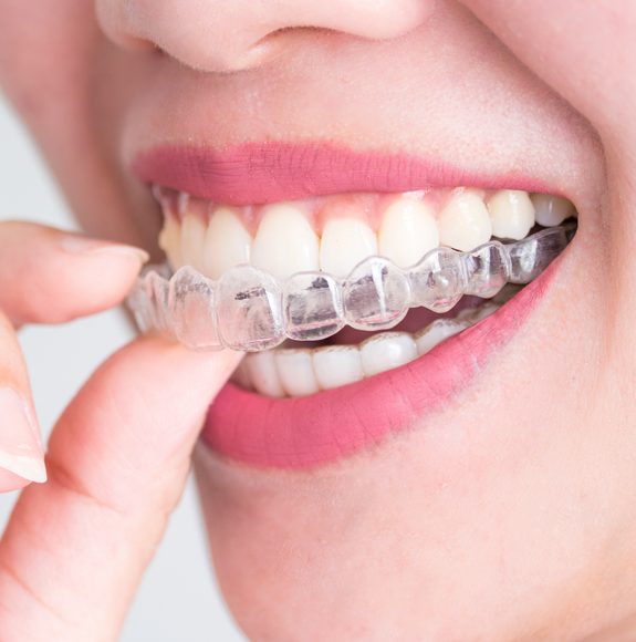 Invisalign Ümraniye