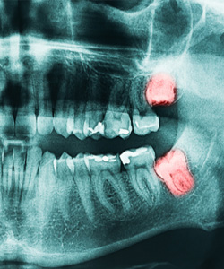 Ümraniye Diş Röntgen Fiyatları